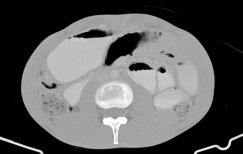 Blunt injury to the small bowel (Radiopaedia 74953-85987 Axial Wide 44).jpg