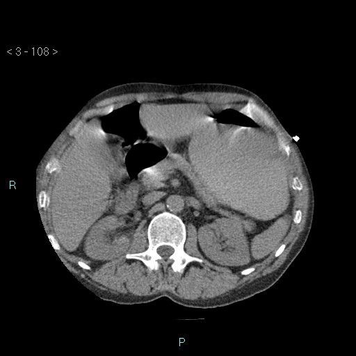 Boerhaave syndrome (Radiopaedia 27683-27897 oral contrast 108).jpg
