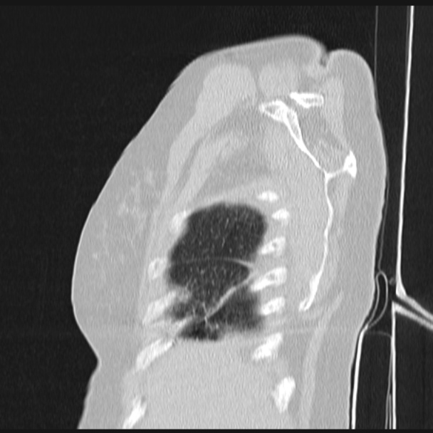 Boerhaave syndrome (Radiopaedia 45644-49799 Sagittal lung window 7).jpg