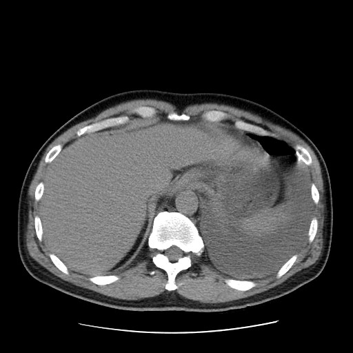 Boerhaave syndrome (Radiopaedia 59796-67310 Axial liver window 55).jpg