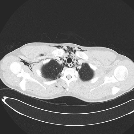 File:Boerhaave syndrome with mediastinal, axillary, neck and epidural free gas (Radiopaedia 41297-44115 Axial lung window 30).jpg