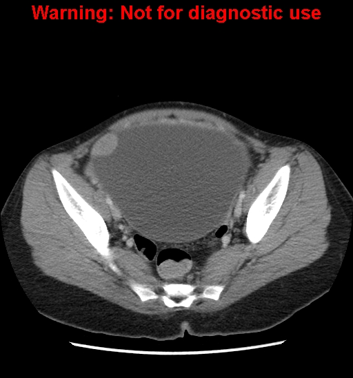 Borderline mucinous cystadenoma of ovary (Radiopaedia 25586-25767 A 92).jpg