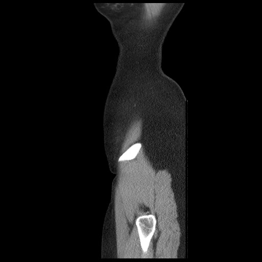 Borderline mucinous tumor (ovary) (Radiopaedia 78228-90808 B 9).jpg