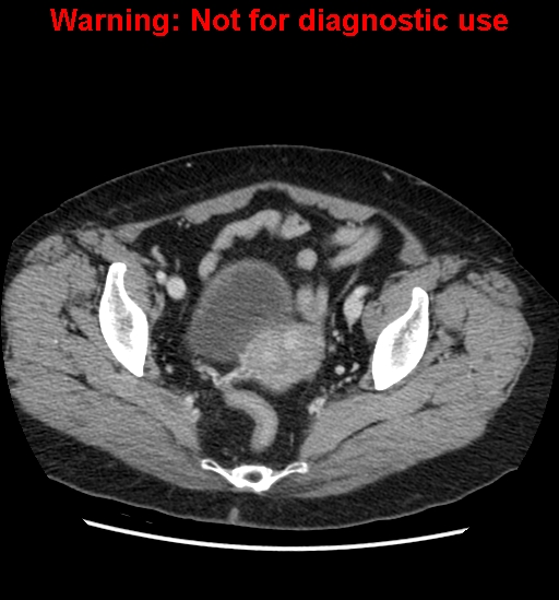 File:Bosniak renal cyst - type II (Radiopaedia 23404-23468 D 63).jpg