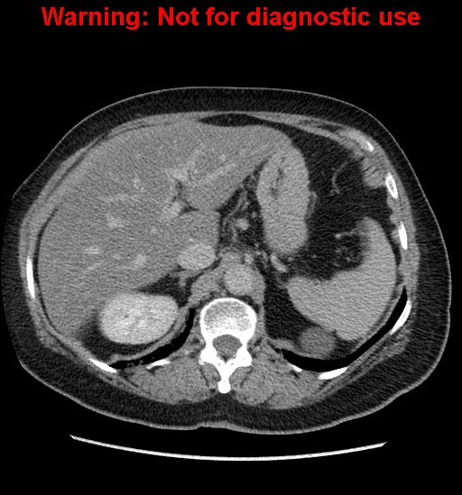 File:Bosniak renal cyst - type II (Radiopaedia 23404-23468 F 15).jpg