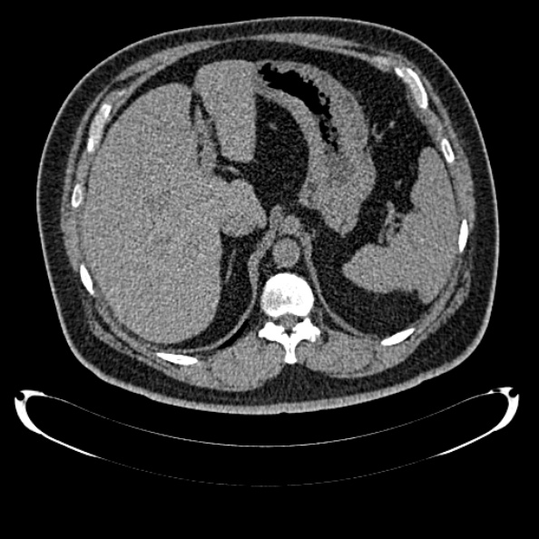 Bosniak renal cyst - type IV (Radiopaedia 24244-24518 Axial non-contrast 98).jpg