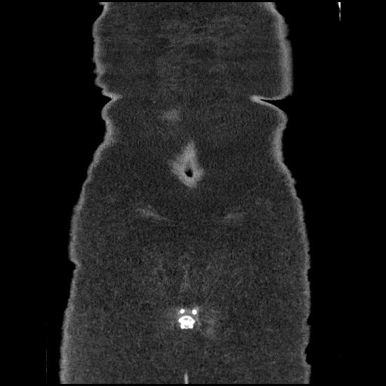 Bowel and splenic infarcts in acute lymphocytic leukemia (Radiopaedia 61055-68913 B 58).jpg