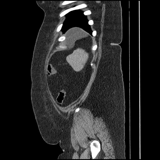 File:Bowel and splenic infarcts in acute lymphocytic leukemia (Radiopaedia 61055-68913 C 19).jpg