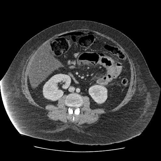 Bowel and splenic infarcts in acute lymphocytic leukemia (Radiopaedia 61055-68915 A 72).jpg
