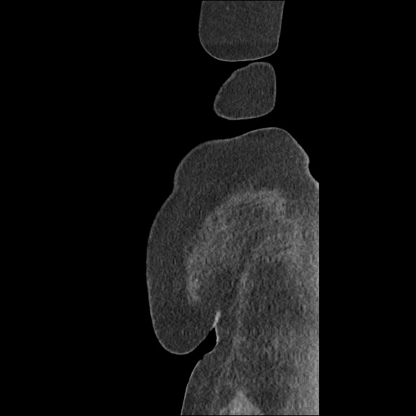 Bowel and splenic infarcts in acute lymphocytic leukemia (Radiopaedia 61055-68915 C 2).jpg