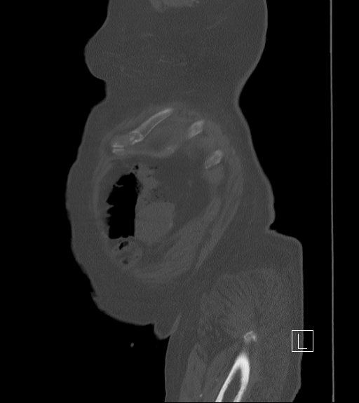 Bowel ischemia secondary to SMA occlusion with extensive portomesenteric venous gas (Radiopaedia 54656-60871 Sagittal bone window 108).jpg