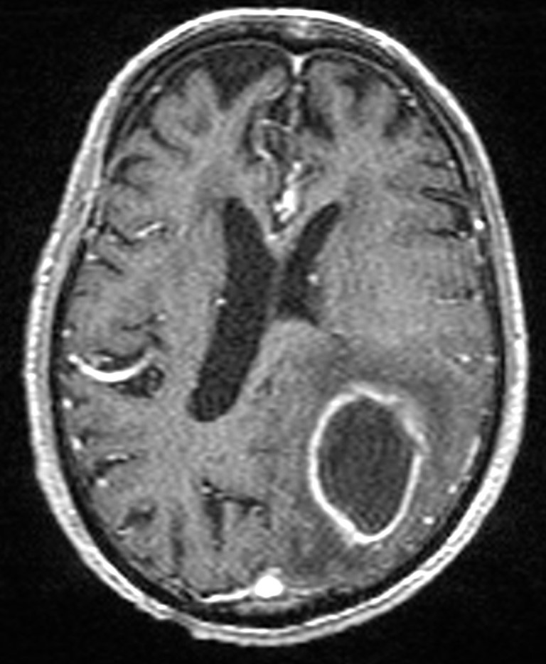 Brain abscess with dual rim sign (Radiopaedia 87566-103938 Axial T1 C+ 102).jpg