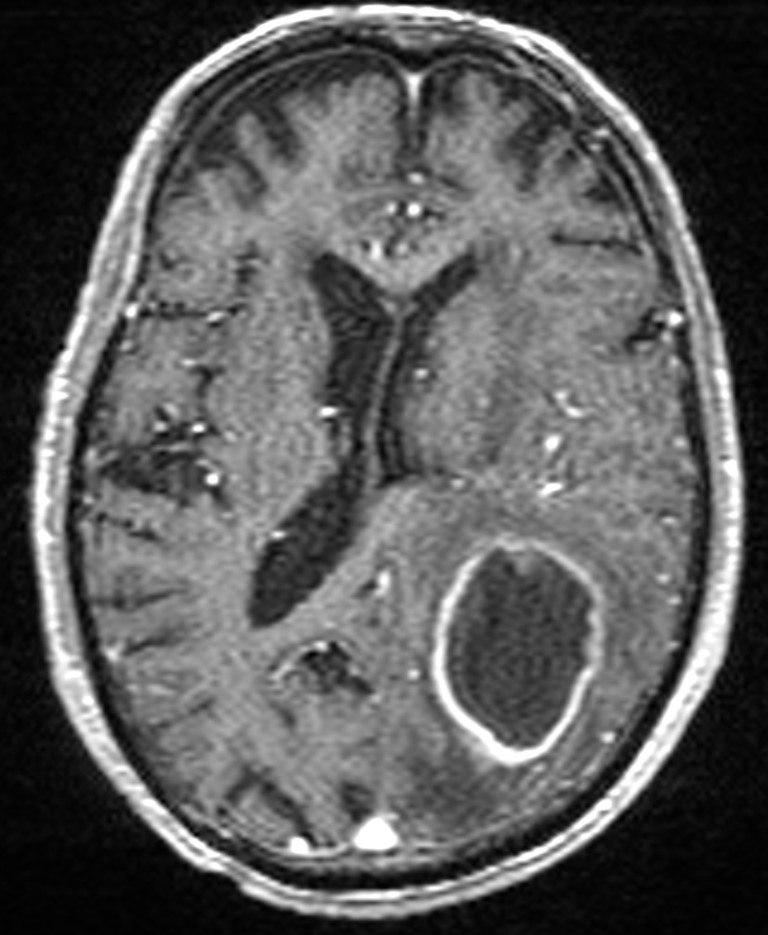 Brain abscess with dual rim sign (Radiopaedia 87566-103938 Axial T1 C+ 96).jpg