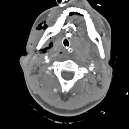 Brain contusions, internal carotid artery dissection and base of skull fracture (Radiopaedia 34089-35339 D 62).png