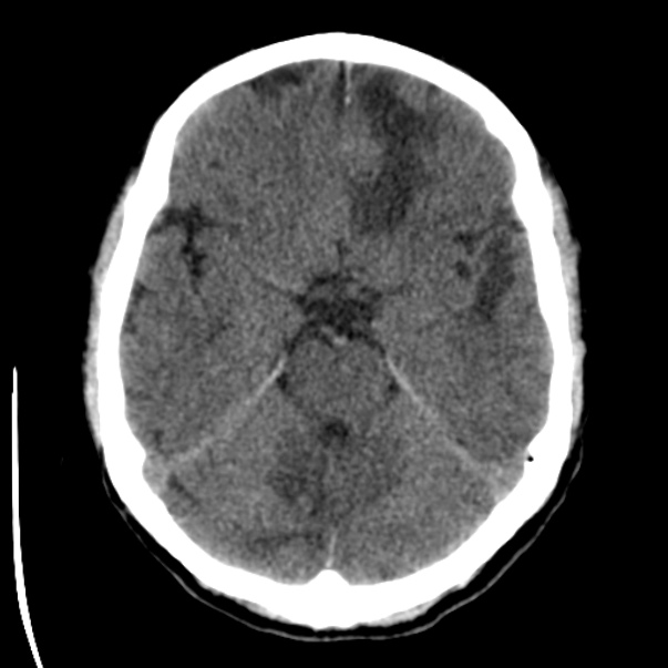 Brain metastases from lung cancer (Radiopaedia 24480-24781 Axial non-contrast 15).jpg