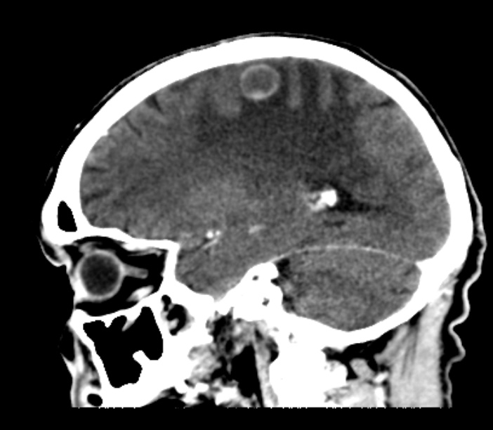 Brain metastases from lung cancer (Radiopaedia 27849-28092 Sagittal C+ delayed 22).jpg