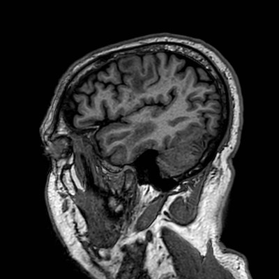 Brain metastases from lung cancer (Radiopaedia 83839-99028 Sagittal T1 106).jpg
