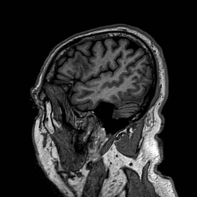 Brain metastases from lung cancer (Radiopaedia 83839-99028 Sagittal T1 19).jpg