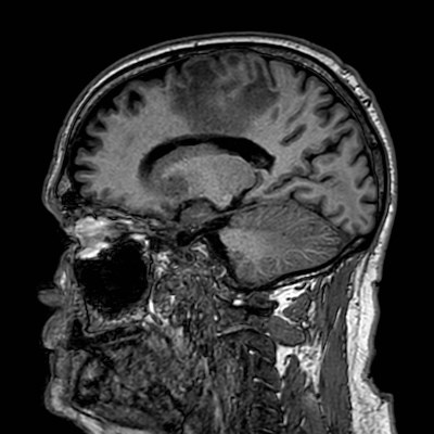 Brain metastases from lung cancer (Radiopaedia 83839-99028 Sagittal T1 79).jpg