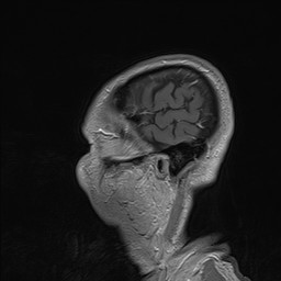 Brain metastasis (Radiopaedia 42617-45761 Sagittal T1 C+ 88).jpg