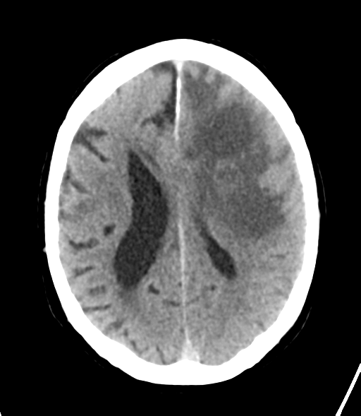 File:Brain metastasis (lung cancer) (Radiopaedia 48289-53177 Axial non-contrast 21).png