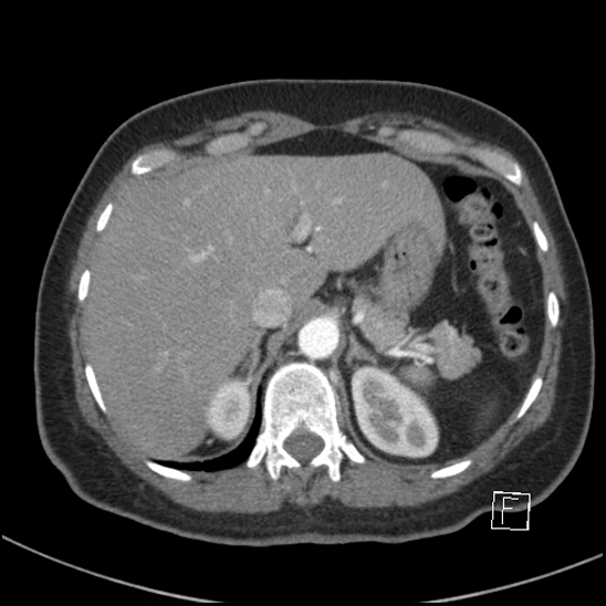 Breast metastases from renal cell cancer (Radiopaedia 79220-92225 A 86).jpg