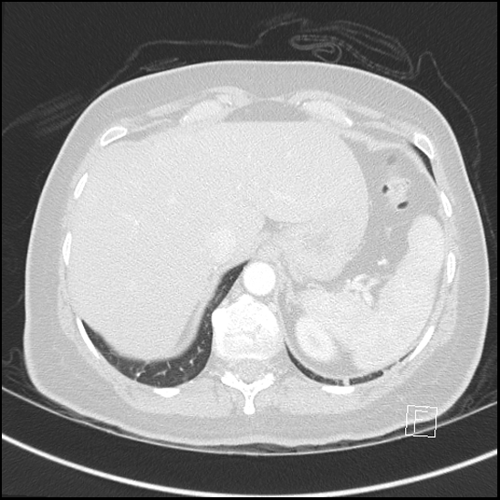 File:Breast metastases from renal cell cancer (Radiopaedia 79220-92225 Axial lung window 77).jpg