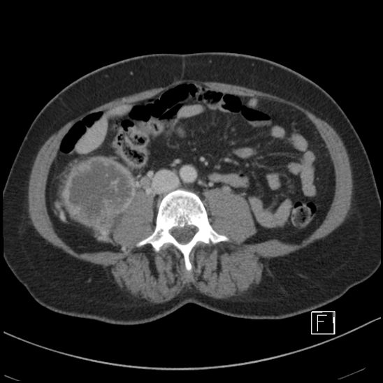 File:Breast metastases from renal cell cancer (Radiopaedia 79220-92225 C 60).jpg