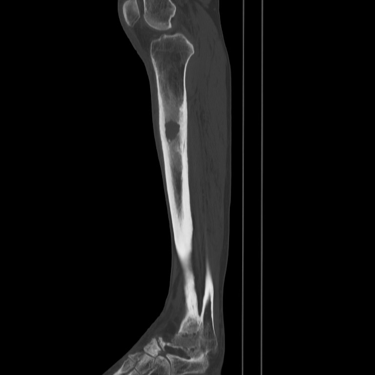 Brodie abscess - tibia (Radiopaedia 66028-75204 Sagittal bone window 38).jpg
