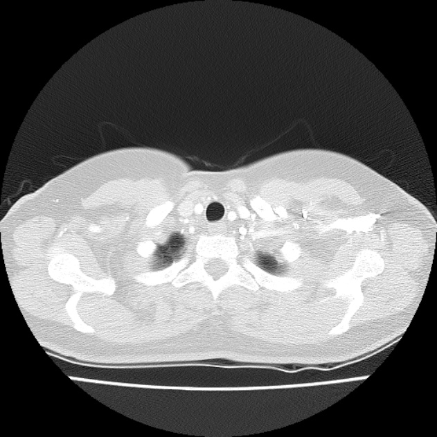 Bronchial atresia (Radiopaedia 22965-22992 Axial lung window 48).jpg