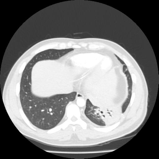 File:Bronchial carcinoid (Radiopaedia 80013-93291 Axial lung window 99).jpg