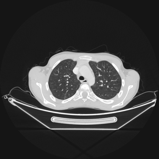 Bronchial carcinoid tumor (Radiopaedia 57187-64090 Axial lung window 19).jpg
