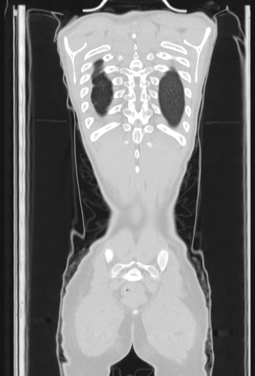 Bronchial carcinoid tumor (Radiopaedia 57187-64090 Coronal lung window 102).jpg