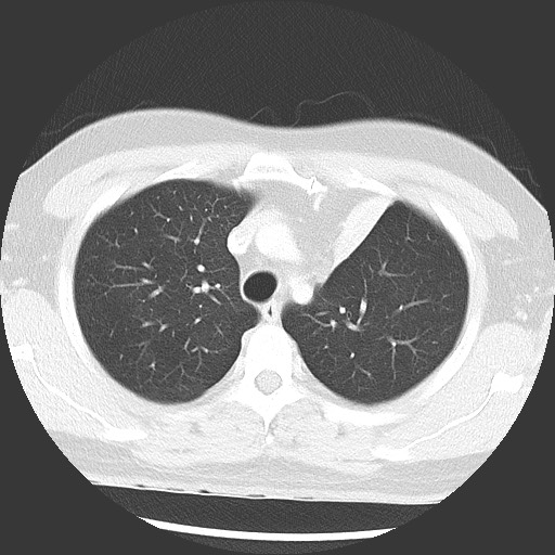 Bronchial carcinoid tumor (Radiopaedia 67377-76764 Axial lung window 19).jpg