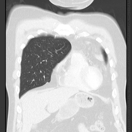 Bronchial carcinoid tumor (Radiopaedia 67377-76764 Coronal lung window 23).jpg