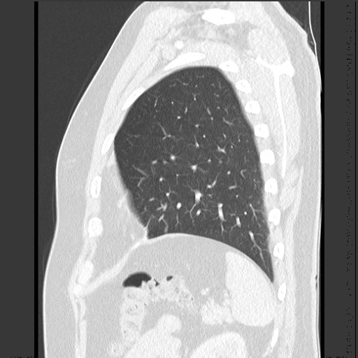 Bronchial carcinoid tumor (Radiopaedia 67377-76764 Sagittal lung window 56).jpg