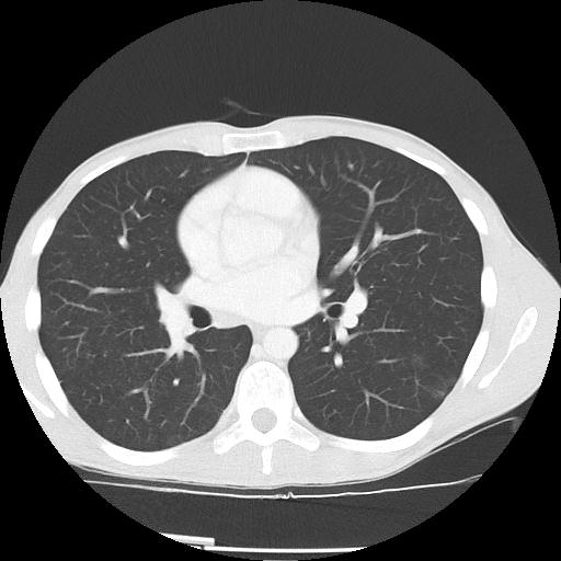Bronchial carcinoid tumor causing right lower lobe collapse (Radiopaedia 83495-98594 Axial lung window 27).jpg