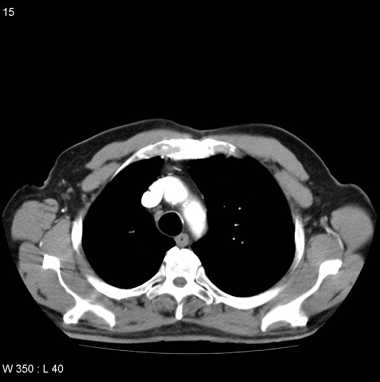 Bronchial carcinoid tumor with right lower lobe collapse (Radiopaedia 29060-29422 A 14).jpg