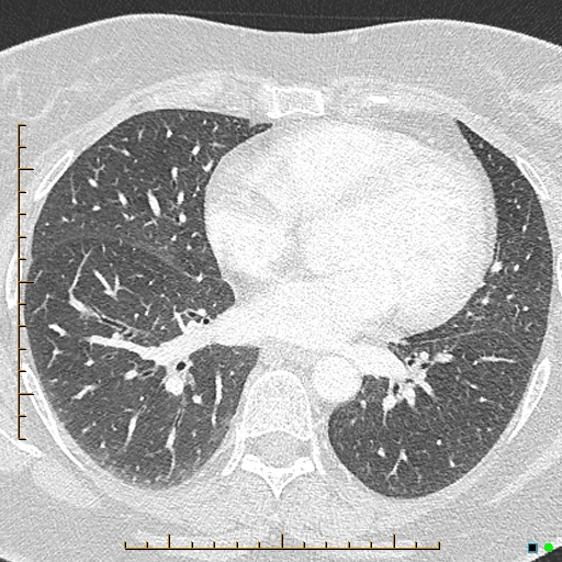 Bronchial diverticula (Radiopaedia 79512-92676 Axial lung window 120).jpg