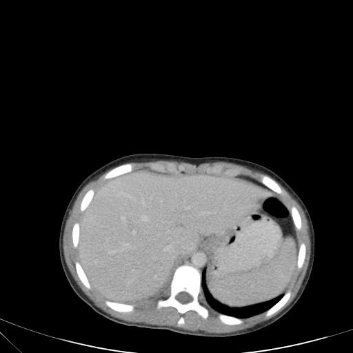 Bronchial mucoepidermoid carcinoma (Radiopaedia 57023-63895 Axial 93).jpg