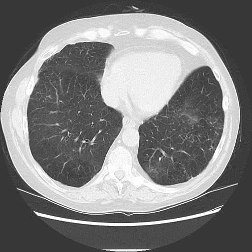 Bronchial stenosis - lung transplant (Radiopaedia 73133-83848 Axial lung window 46).jpg