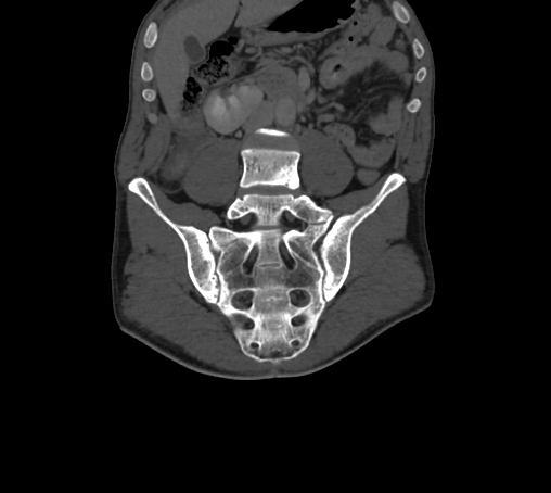 Bronchiectasis in Crohn disease (Radiopaedia 60311-67977 Coronal bone window 34).jpg