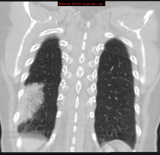 Bronchoalveolar carcinoma (BAC) (Radiopaedia 13436-13392 Coronal lung window 51).jpg