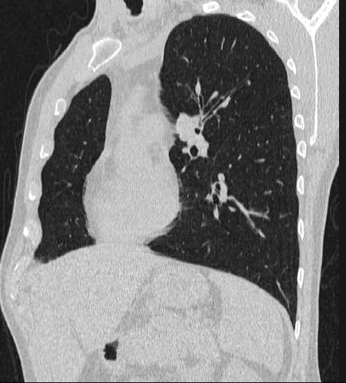 File:Bronchocele (Radiopaedia 60676-68429 Oblique lung window 7).jpg