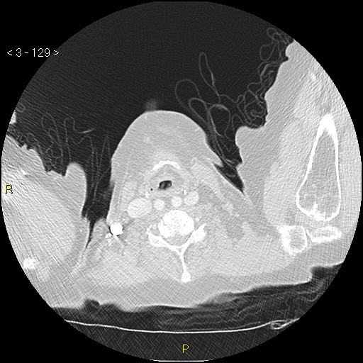 Bronchogenic carcinoma as an incidental finding (Radiopaedia 16453-16130 Axial lung window 129).jpg