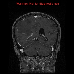File:Bronchogenic carcinoma brain metastasis (Radiopaedia 9286-9969 Coronal T1 1).jpg