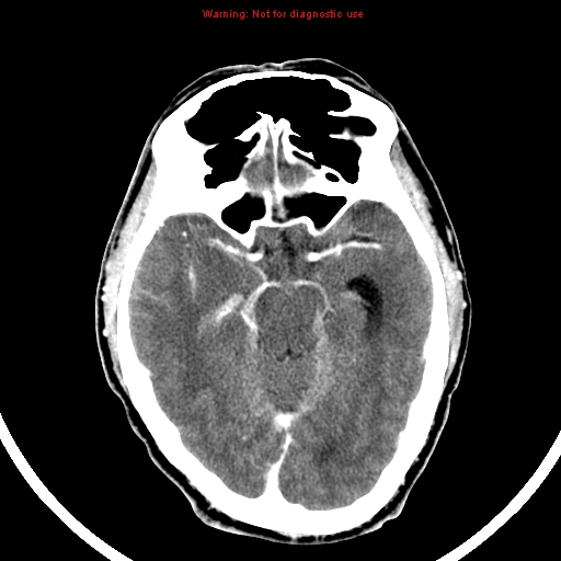 File:Bronchogenic carcinoma brain metastasis (Radiopaedia 9286-9970 B 11).jpg