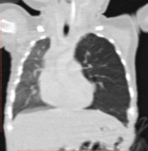 File:Bronchogenic cyst (Radiopaedia 78599-91409 Coronal lung window 99).jpg