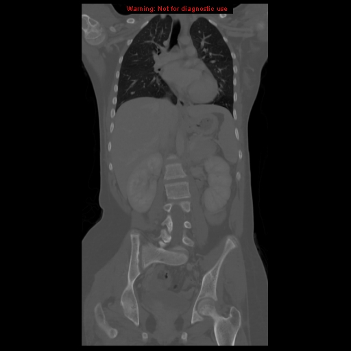 File:Brown tumor (Radiopaedia 12318-12596 D 38).jpg