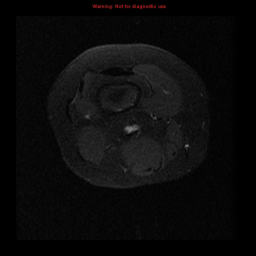 File:Brown tumor (Radiopaedia 12318-12597 Axial T1 C+ fat sat 1).jpg